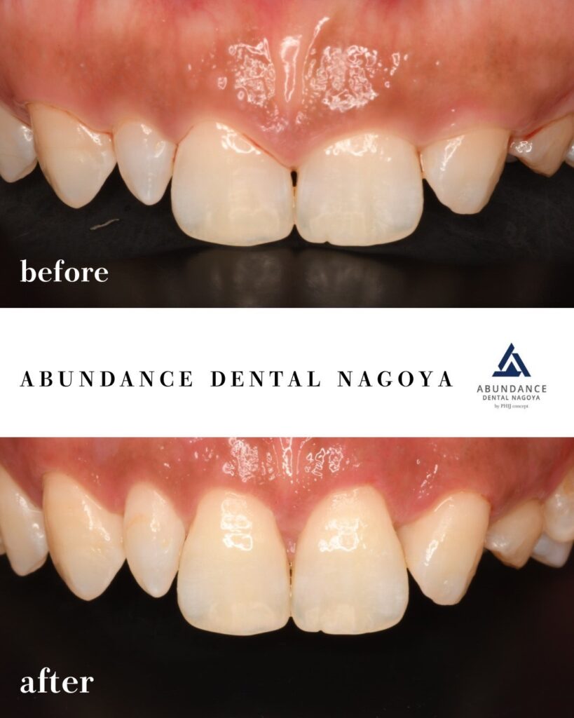 歯茎が見える笑顔を自然に整える ― 審美的歯冠長延長術について