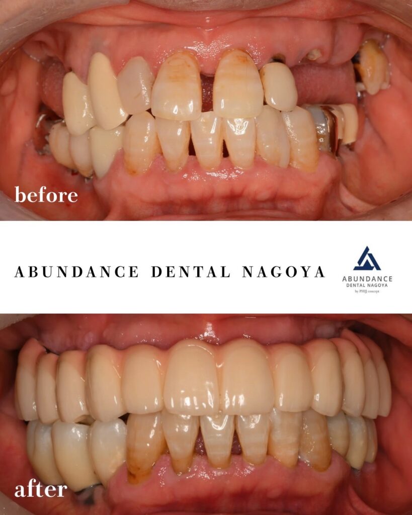 虫歯と歯周病をしっかり治したい方へ ― 上下顎インプラント治療(オールオン6+セラミッククラウン)