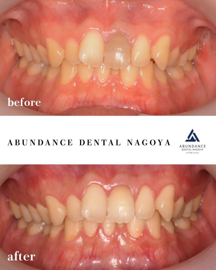 神経を取った歯の変色を自然に改善 ― ウォーキングブリーチ(ホワイトニング)