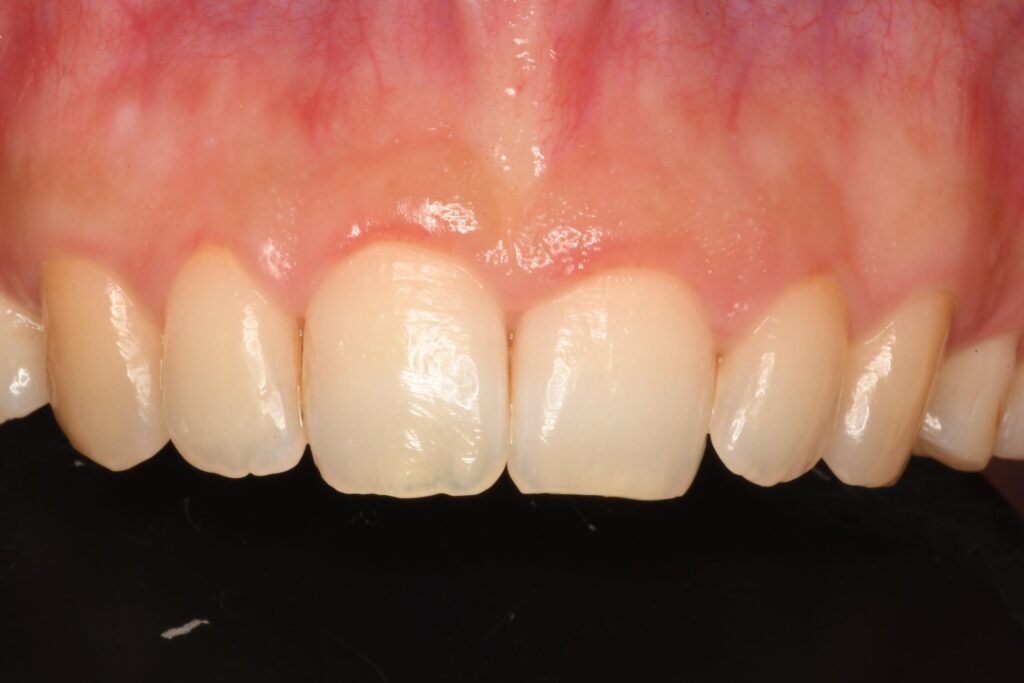 ガミースマイル手術｜当日のビフォーアフター