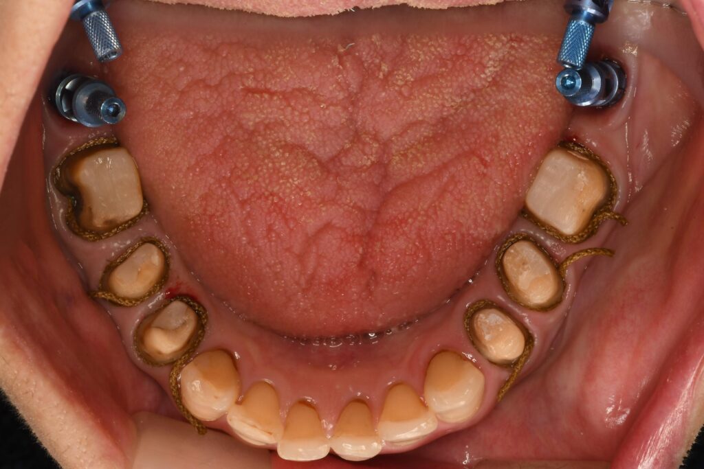 本日はインプラントを含めた「8本同時の型取り」を行いました