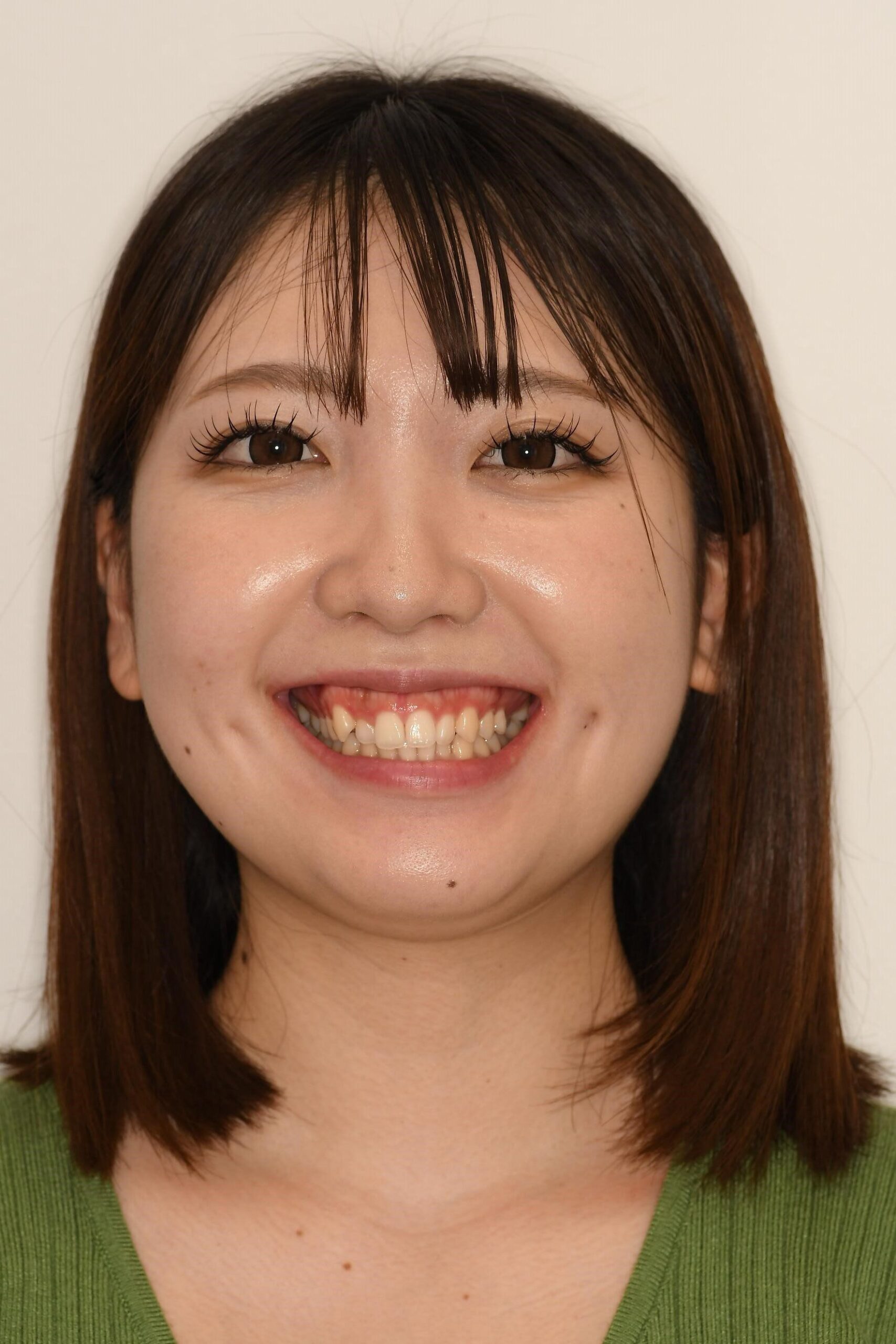 【症例紹介】ガミースマイルを改善した審美治療（顔写真ビフォーアフター）