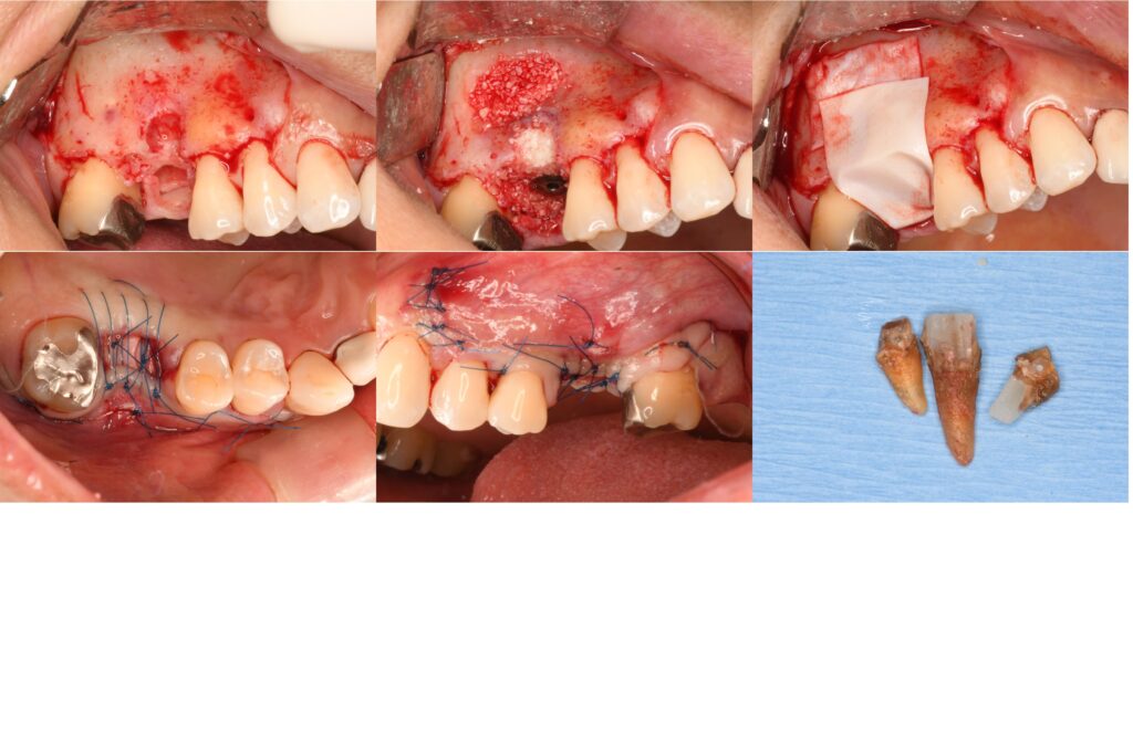 右上の奥歯（6番）が割れてしまった患者さんのインプラント治療を行いました。
