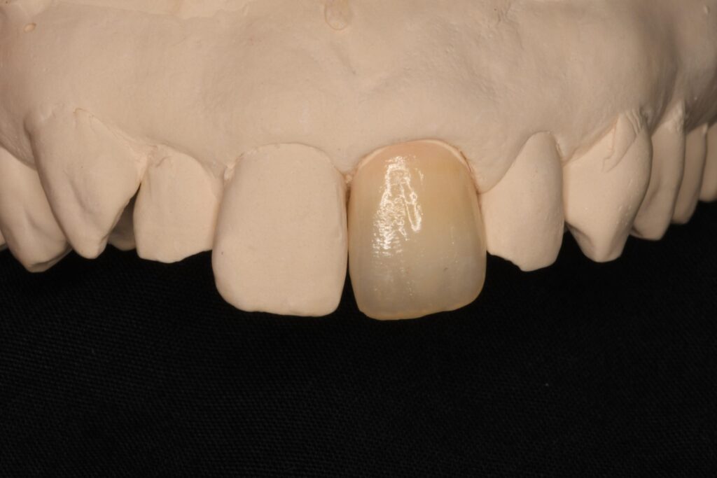 マージンをより美しく、仕上がりを最高の状態へ——当院がセラミック治療にかけるこだわり