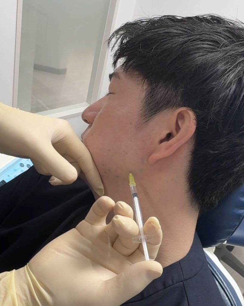 咬筋ボトックス治療を行っています