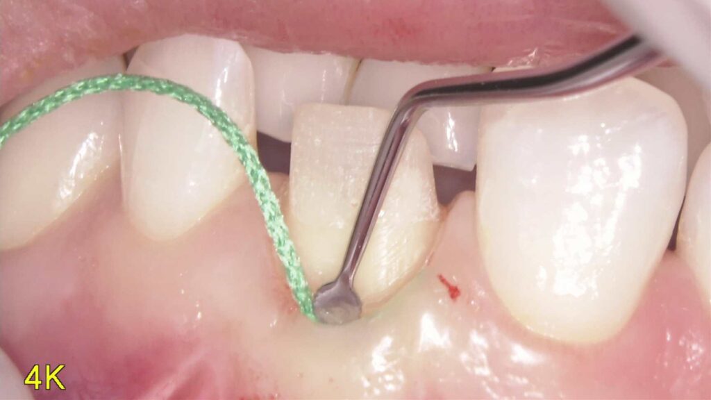 より綺麗な被せ物を作るために、当院が大切にしている“ひと手間”とは？