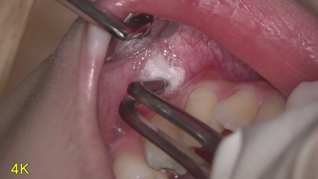 痛くない治療のために——当院の麻酔へのこだわり