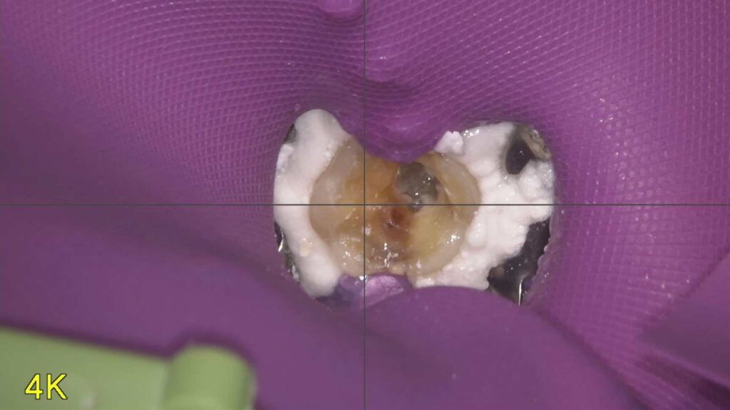 【当院のこだわり】根管治療ではラバーダムを使用します