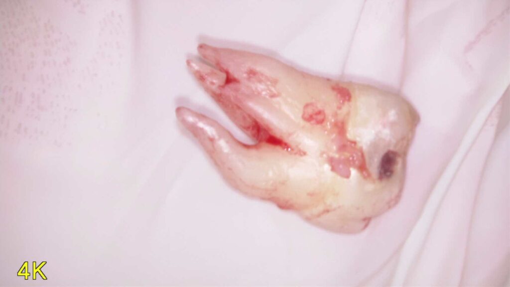 親知らずの抜歯は怖い？