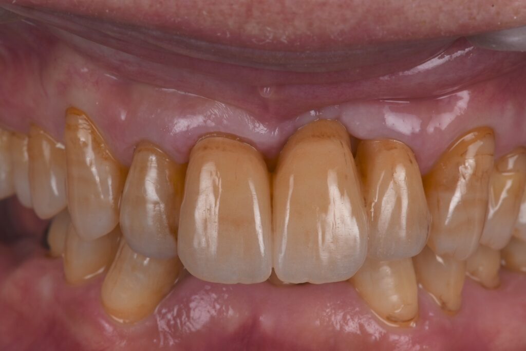 【症例紹介】どこが欠損だったかわかりますか？前歯のセラミックブリッジ治療