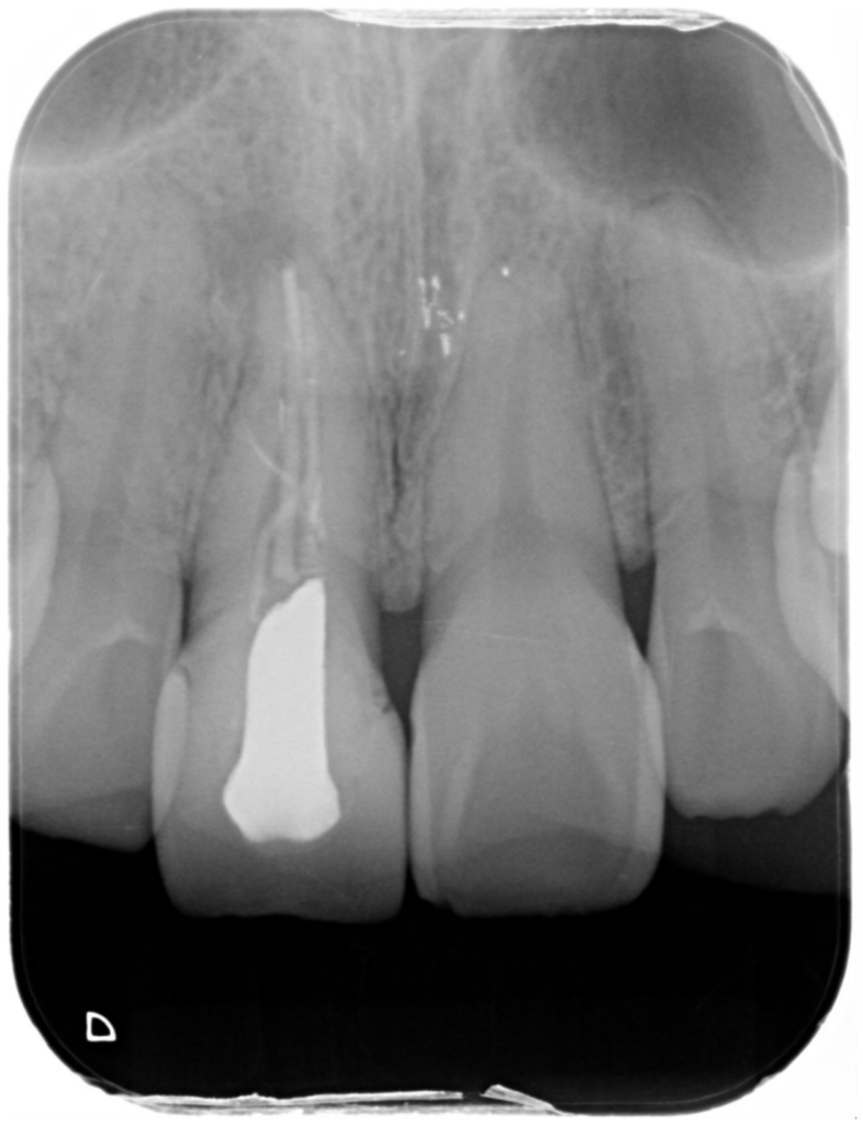 「前歯で噛むと痛い」―被せ物の中で起きていたこと【保険診療】