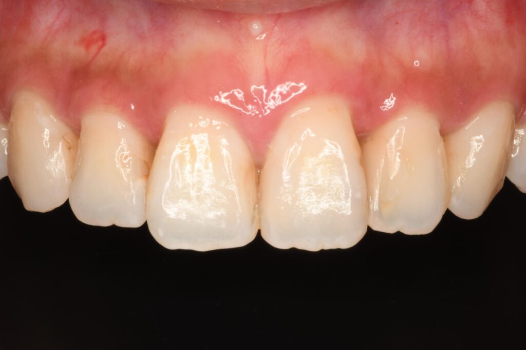 「結婚式2日前」前歯の詰め物を全部きれいにしたい ― 即日で整えた審美CR修復【保険診療】