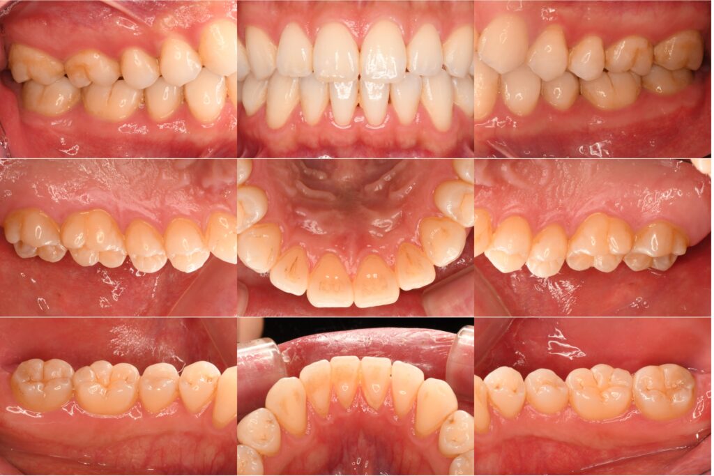 小さなむし歯を見逃さないために（保険診療）