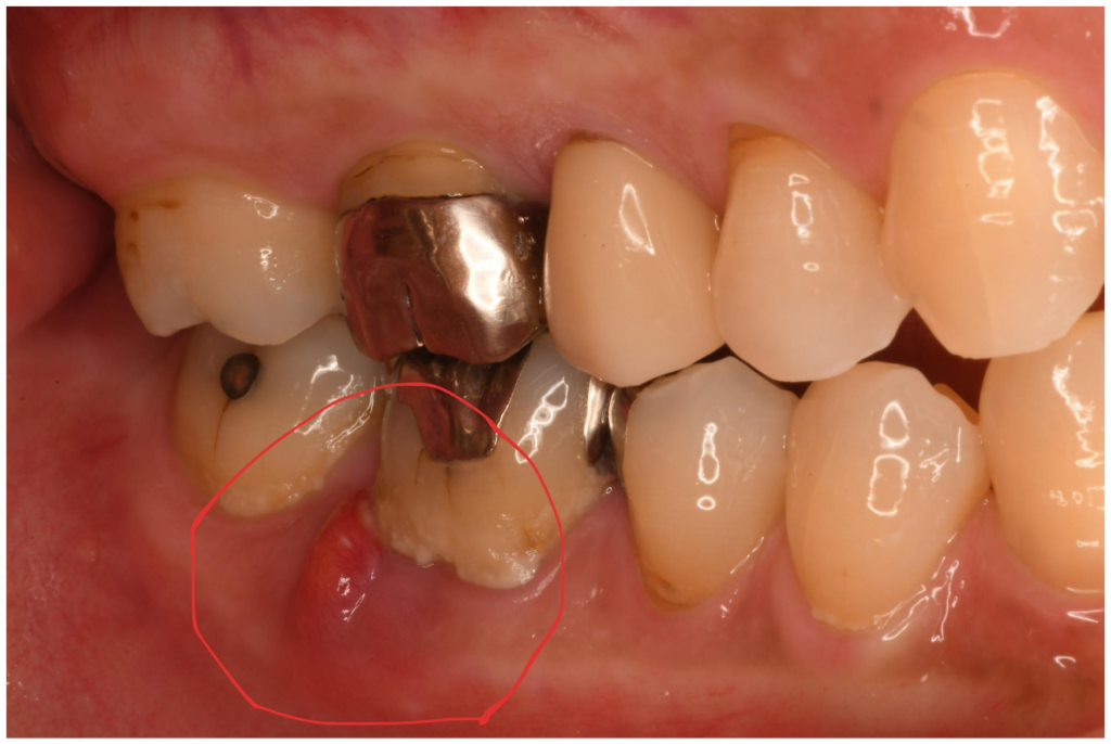 右下6番の痛み・歯ぐきの腫れで来院された方の治療（根管治療）【保険診療】