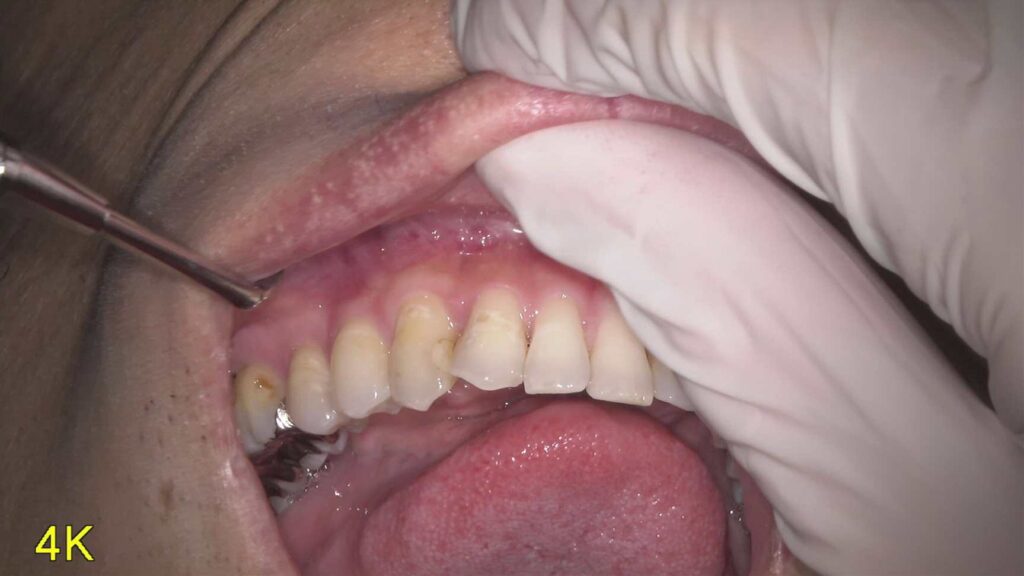 左下2・3・4番の虫歯を即日CRで治療しました【保険診療】