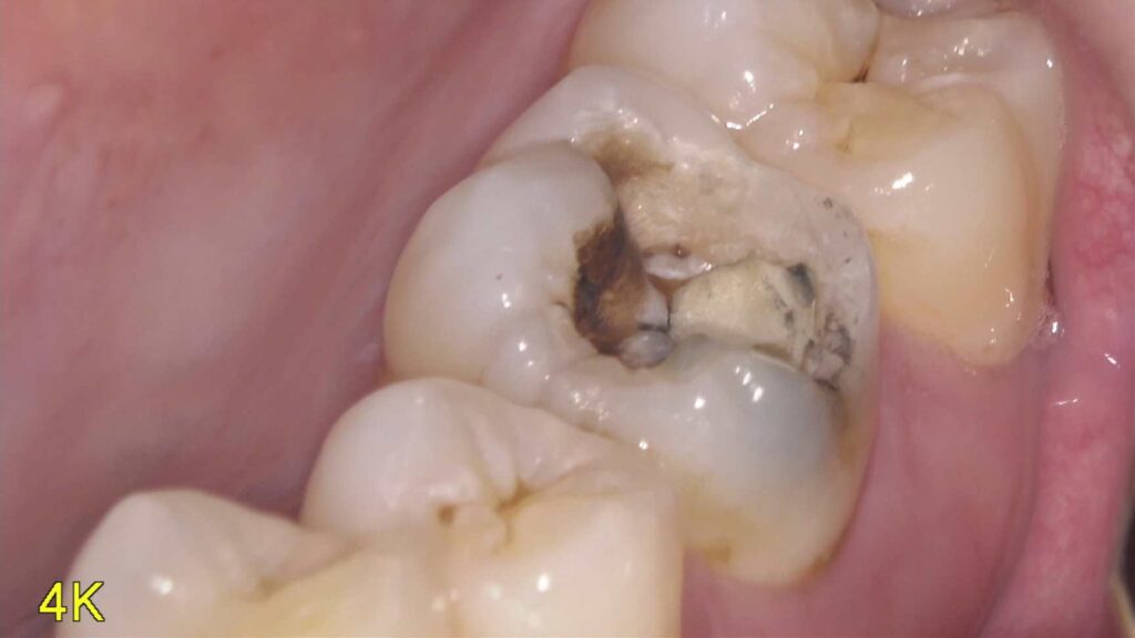 右上奥歯の銀歯が取れた方の「即日・短時間」修復を行いました