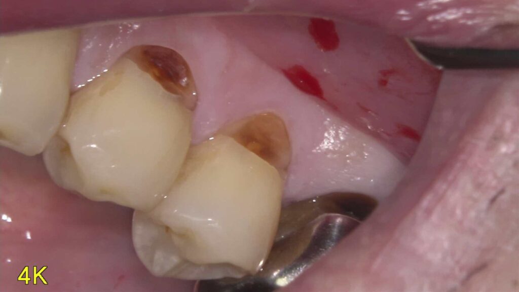 歯茎の近くが欠けて見た目が気になる…コンポジットレジンで即日修復（保険診療）