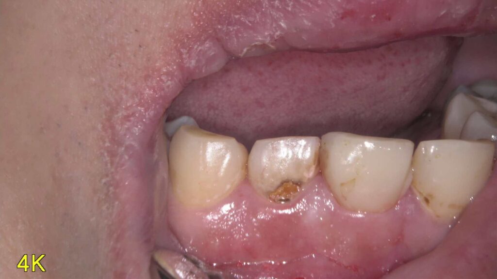 【治療ブログ】前歯の見た目が気になる…コンポジットレジンで自然に改善しました【保険診療】