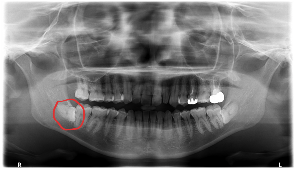 親知らずの抜歯（下顎・埋伏智歯）を行いました【保険診療】