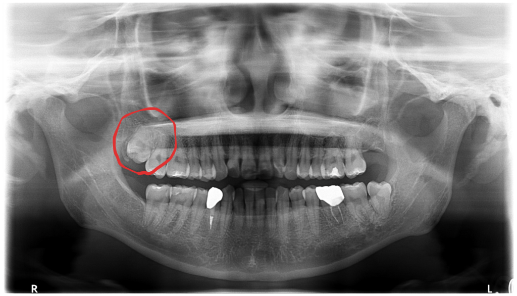 右上の親知らずが歯ぐきを刺激…当日抜歯で痛みを解決しました🦷【保険診療】