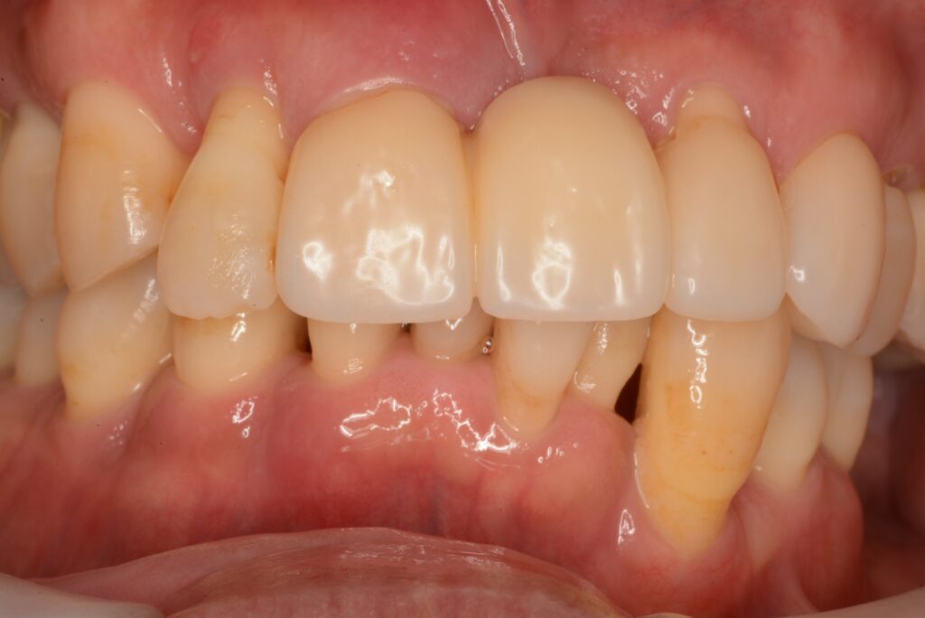 上顎前歯のセラミックをやり直し、自然な見た目へ整えた症例