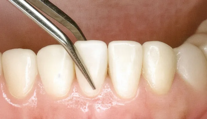 歯の動揺度検査